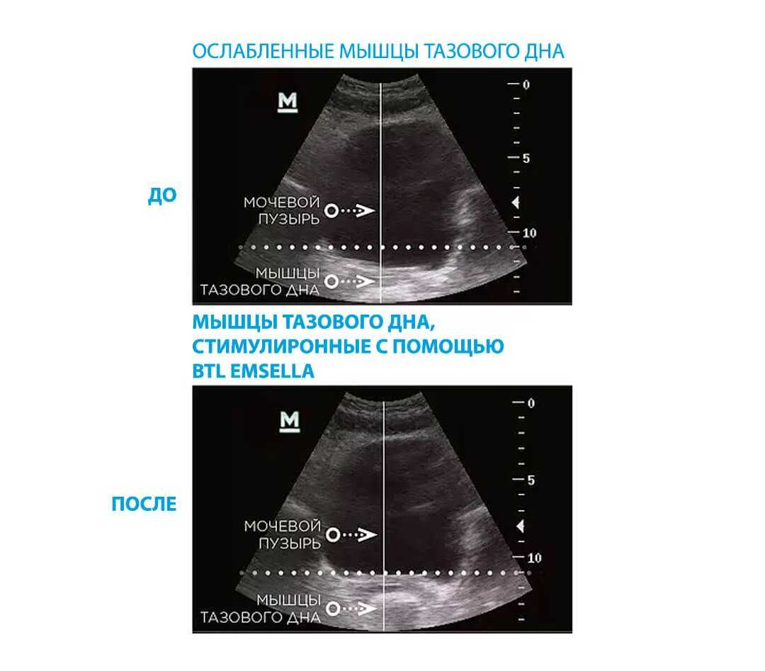 Как происходит процедура Эмселла в клинике Горчаковой?